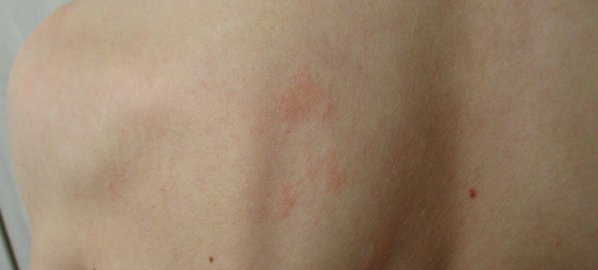Czeka nas pandemia nowej choroby? WHO zwołuje specjalny komitet: możliwe “zagrożenie o zasięgu międzynarodowym”